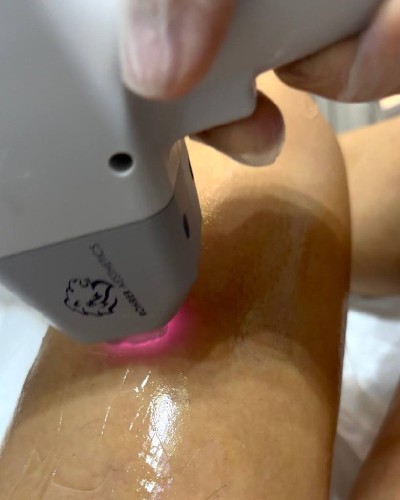 Advanced technology for Laser Hair Removal NYC at Lumera Skin Lab.