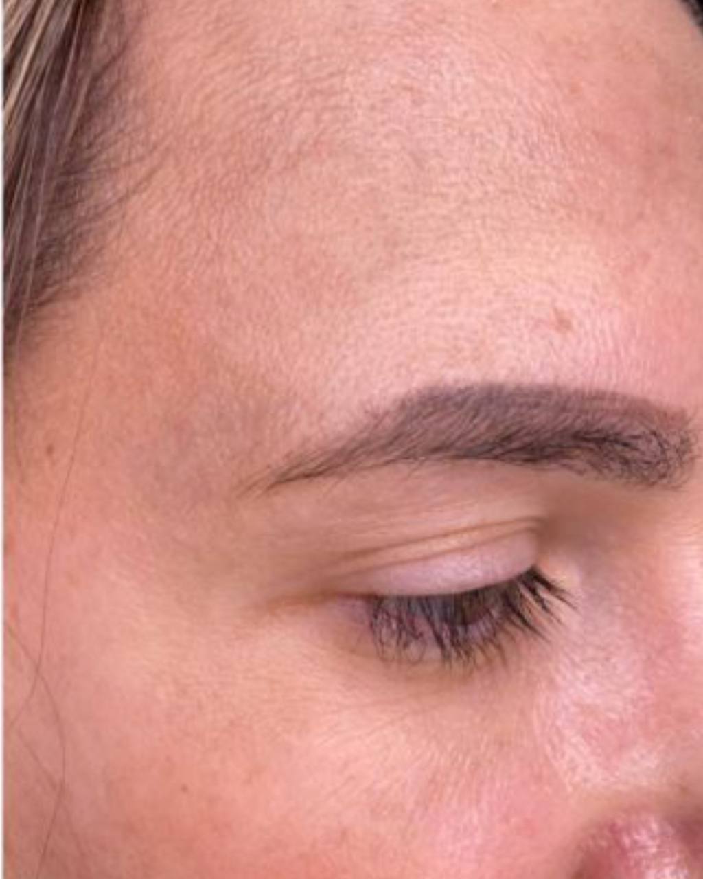 Pigmentation Treatment NYC