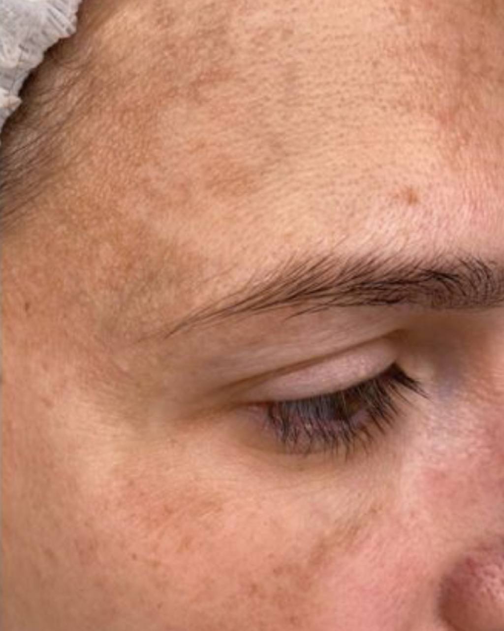 Pigmentation Treatment NYC