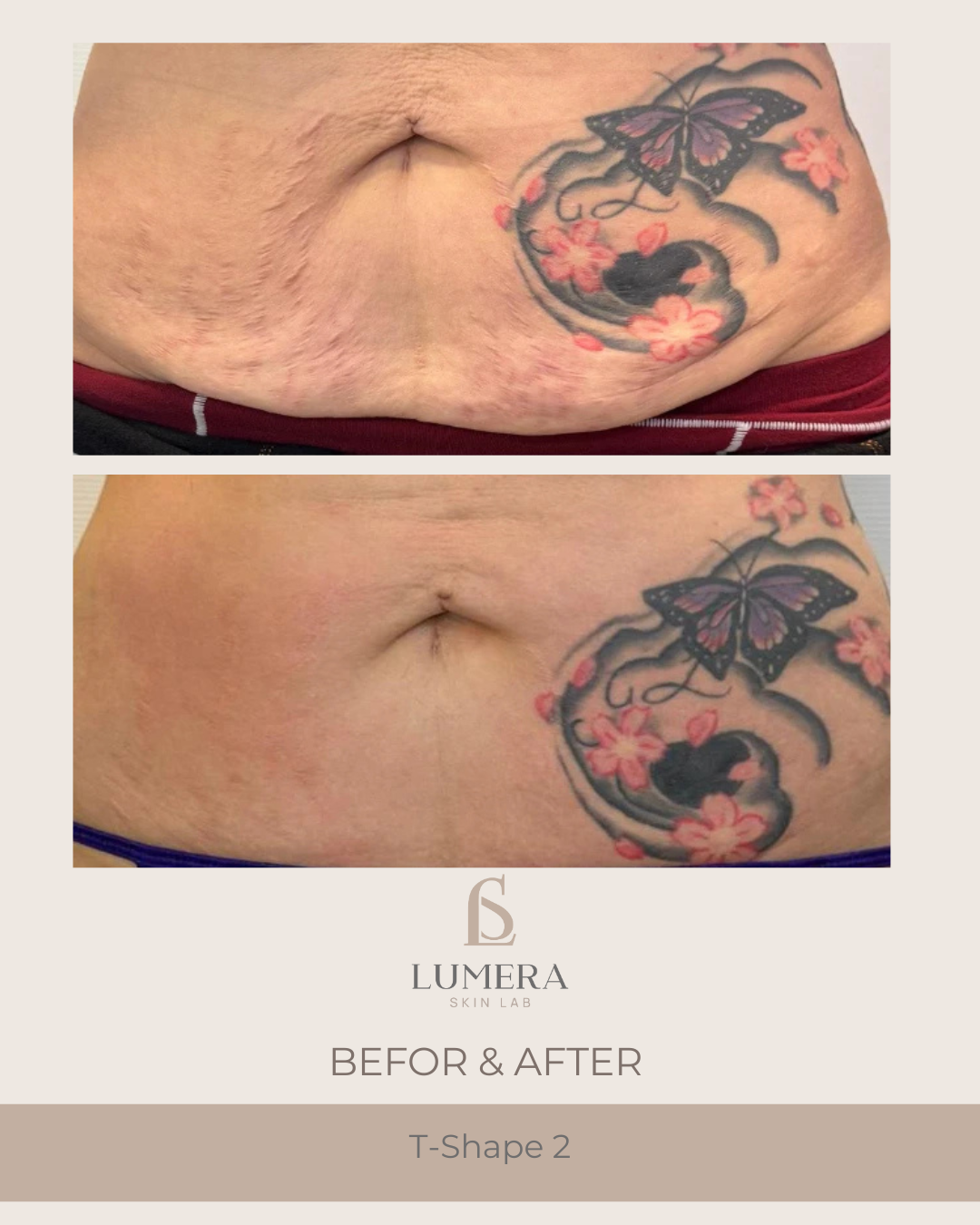 T-Shape 2 Body Contouring NYC