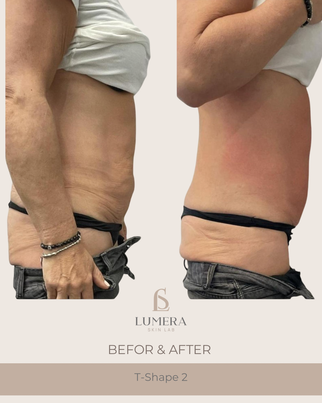 T-Shape 2 Body Contouring NYC