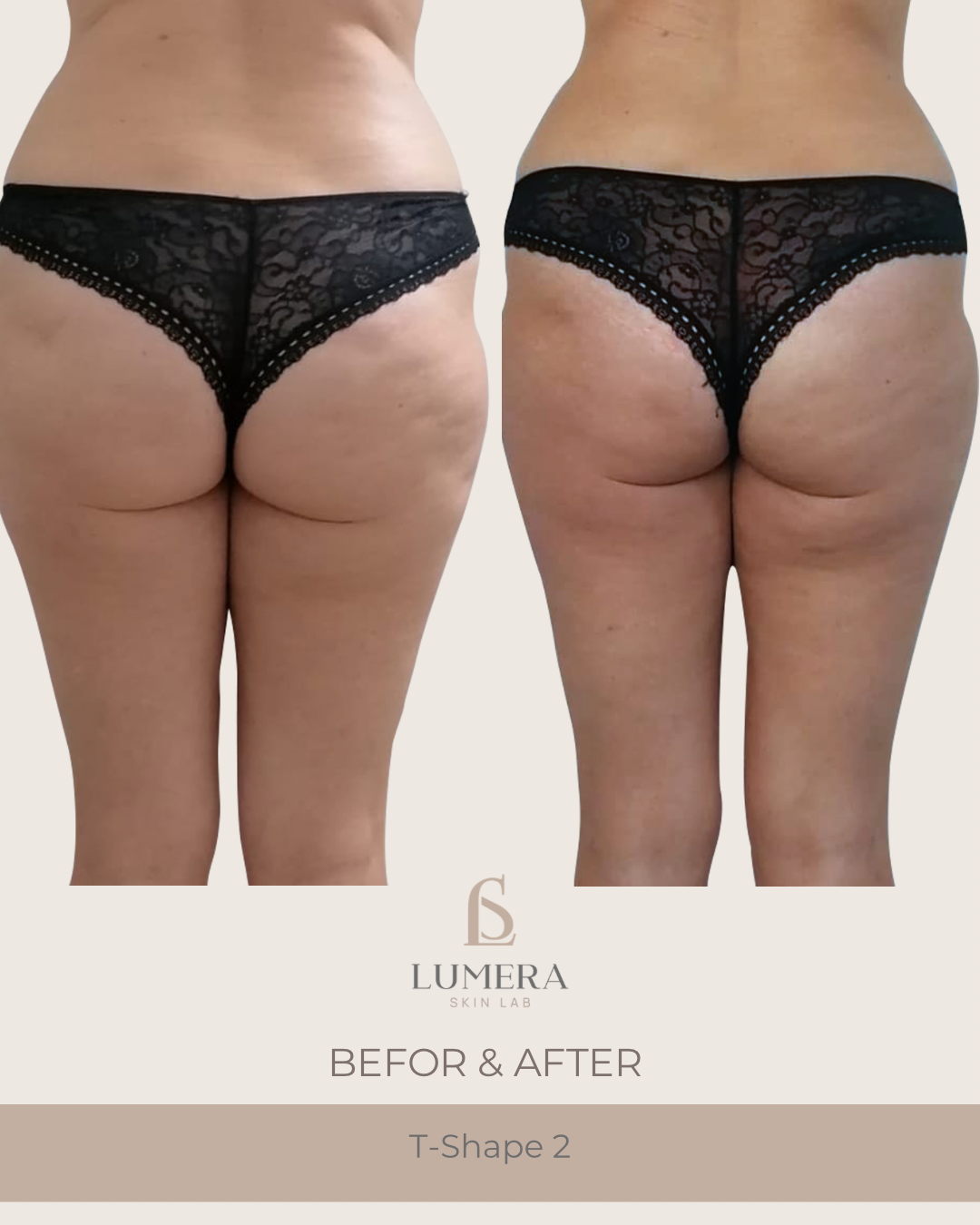 T-Shape 2 Body Contouring NYC