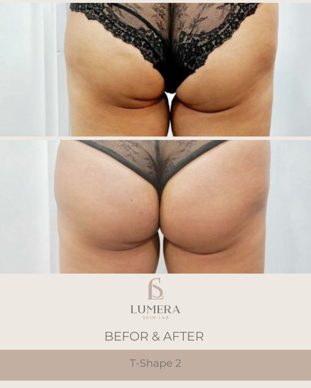 T-Shape 2 Body Contouring NYC