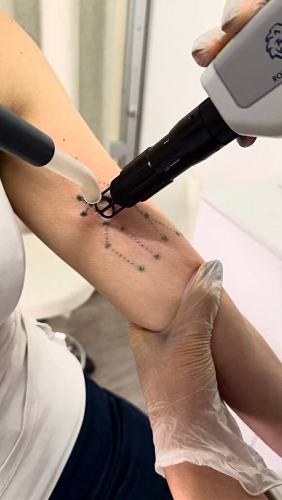 Comfortable and fast Laser Tattoo Removal NYC experience