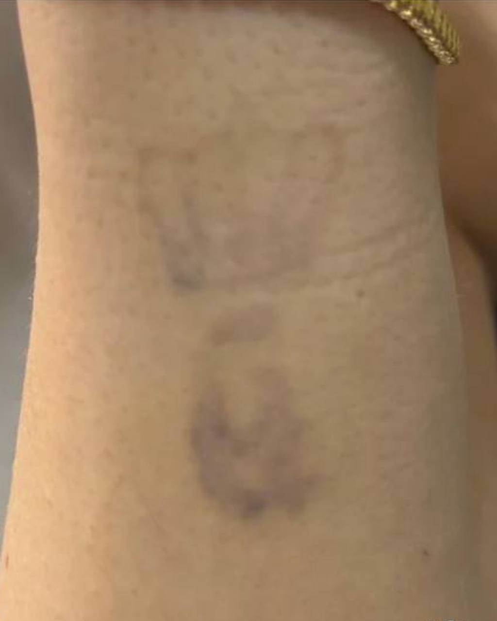 Before and after progress of Laser Tattoo Removal NYC