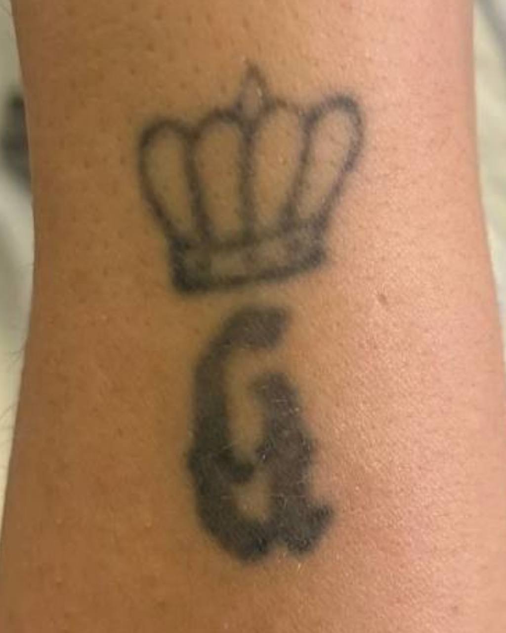 Before and after progress of Laser Tattoo Removal NYC