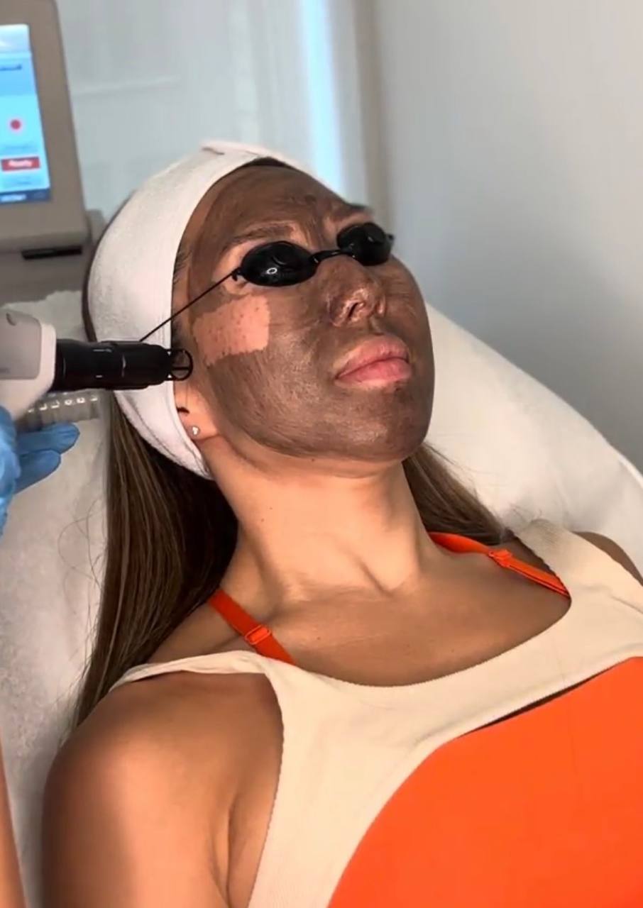 Zero downtime results from Carbon Laser Facial NYC.