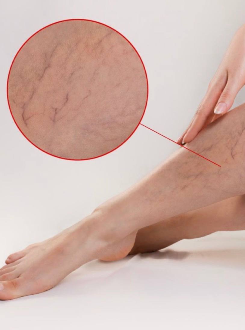 aser spider vein removal NYC results, Treating facial veins in Midtown Manhatta