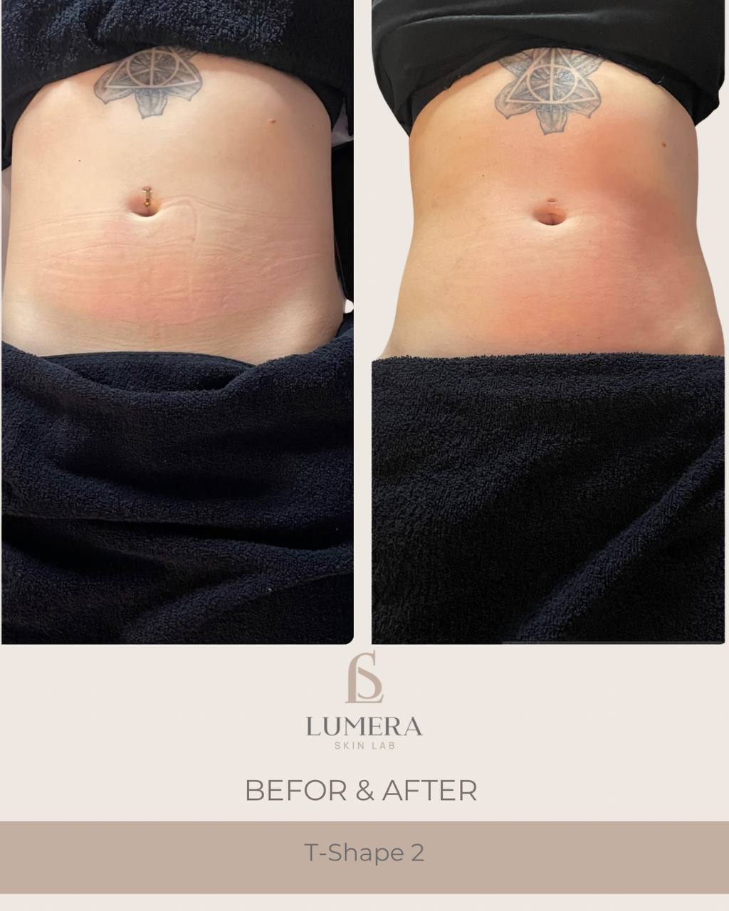 T-Shape 2 Body Contouring NYC