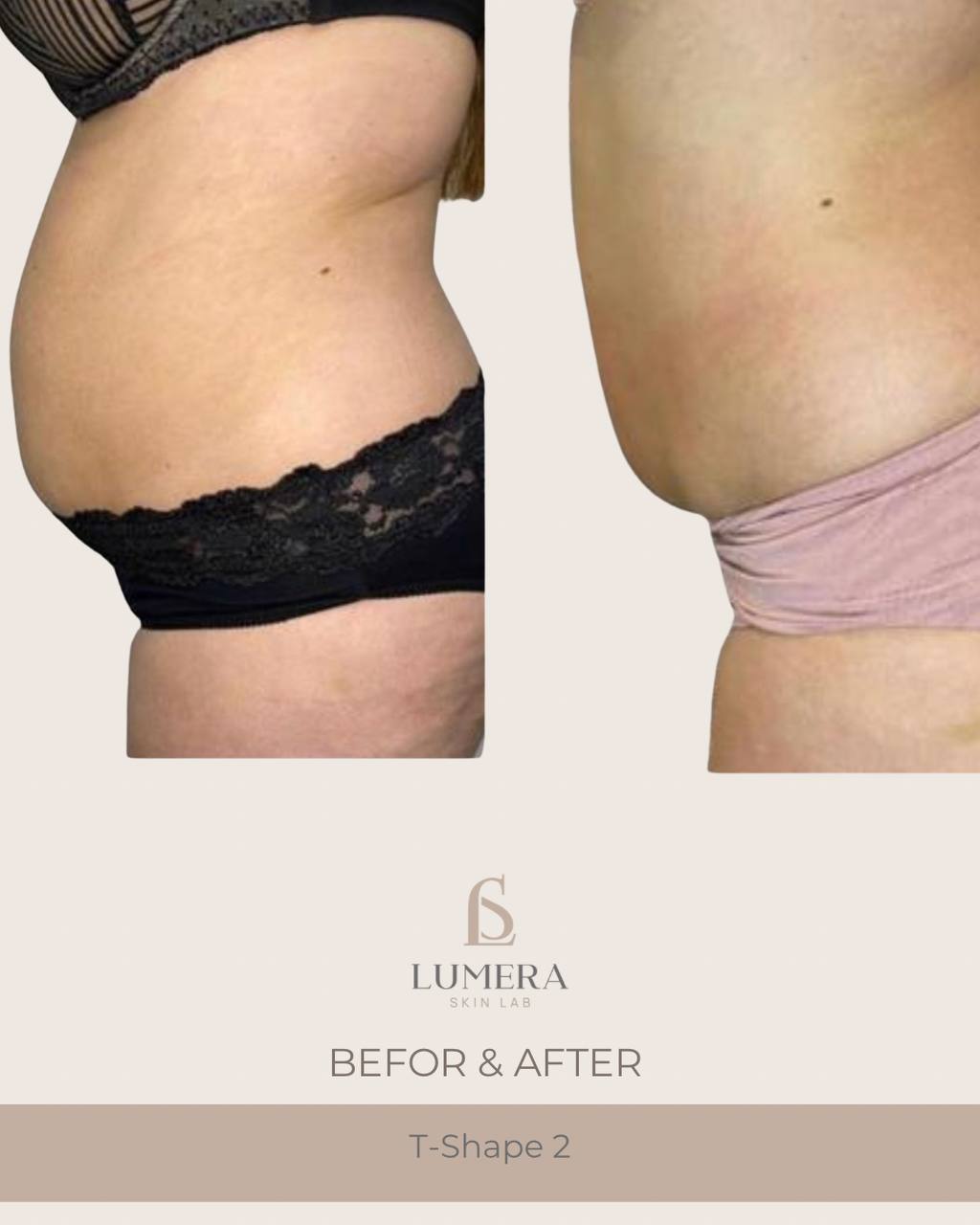 T-Shape 2 Body Contouring NYC