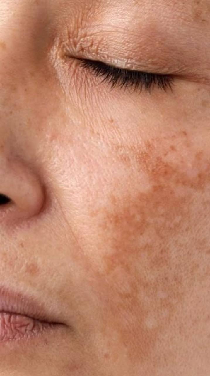 Pigmentation Treatment NYC