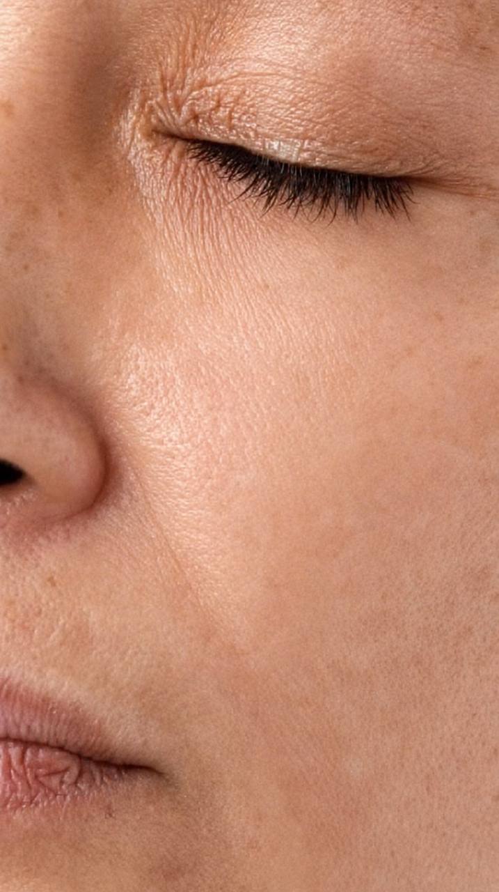Pigmentation Treatment NYC