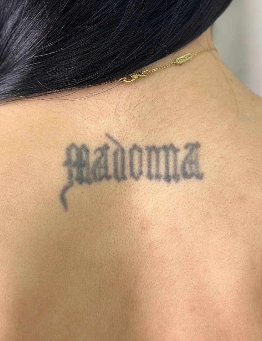 Expert Tattoo Removal NYC treatment at Lumera Skin Lab