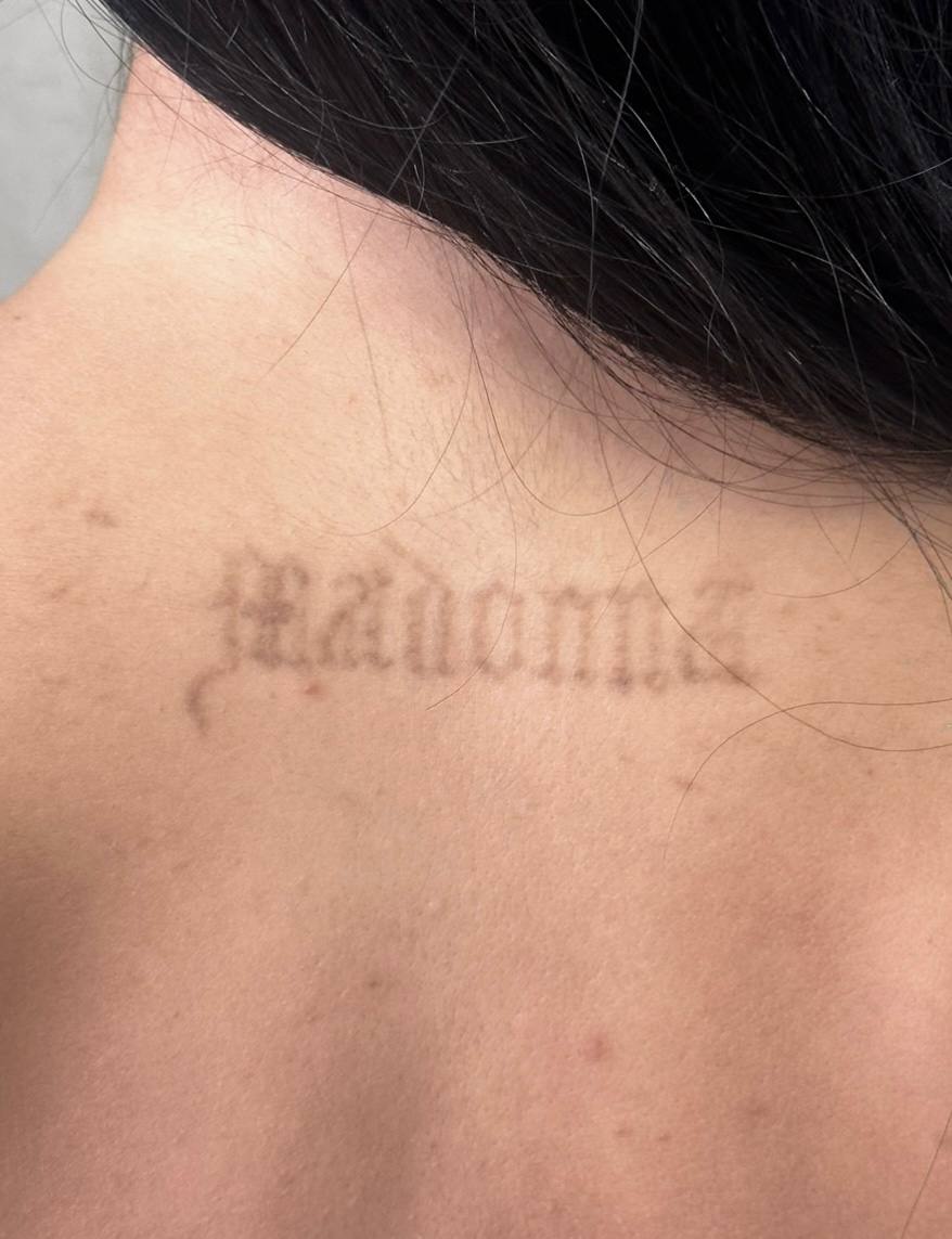 Expert Tattoo Removal NYC treatment at Lumera Skin Lab