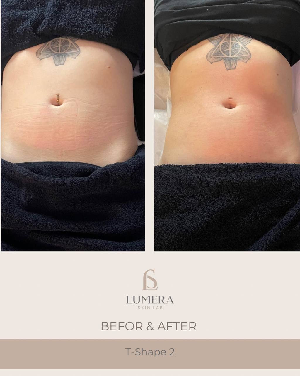 Before and after results of lymphatic drainage massage NYC at Lumera Skin Lab in Midtown Manhattan showing visible body sculpting and de-bloating.