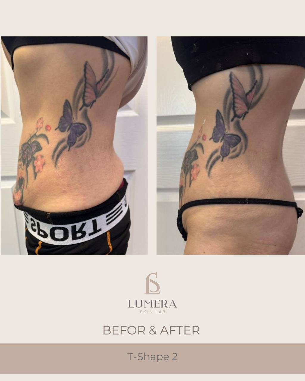 Before and after results of lymphatic drainage massage NYC at Lumera Skin Lab in Midtown Manhattan showing visible body sculpting and de-bloating.