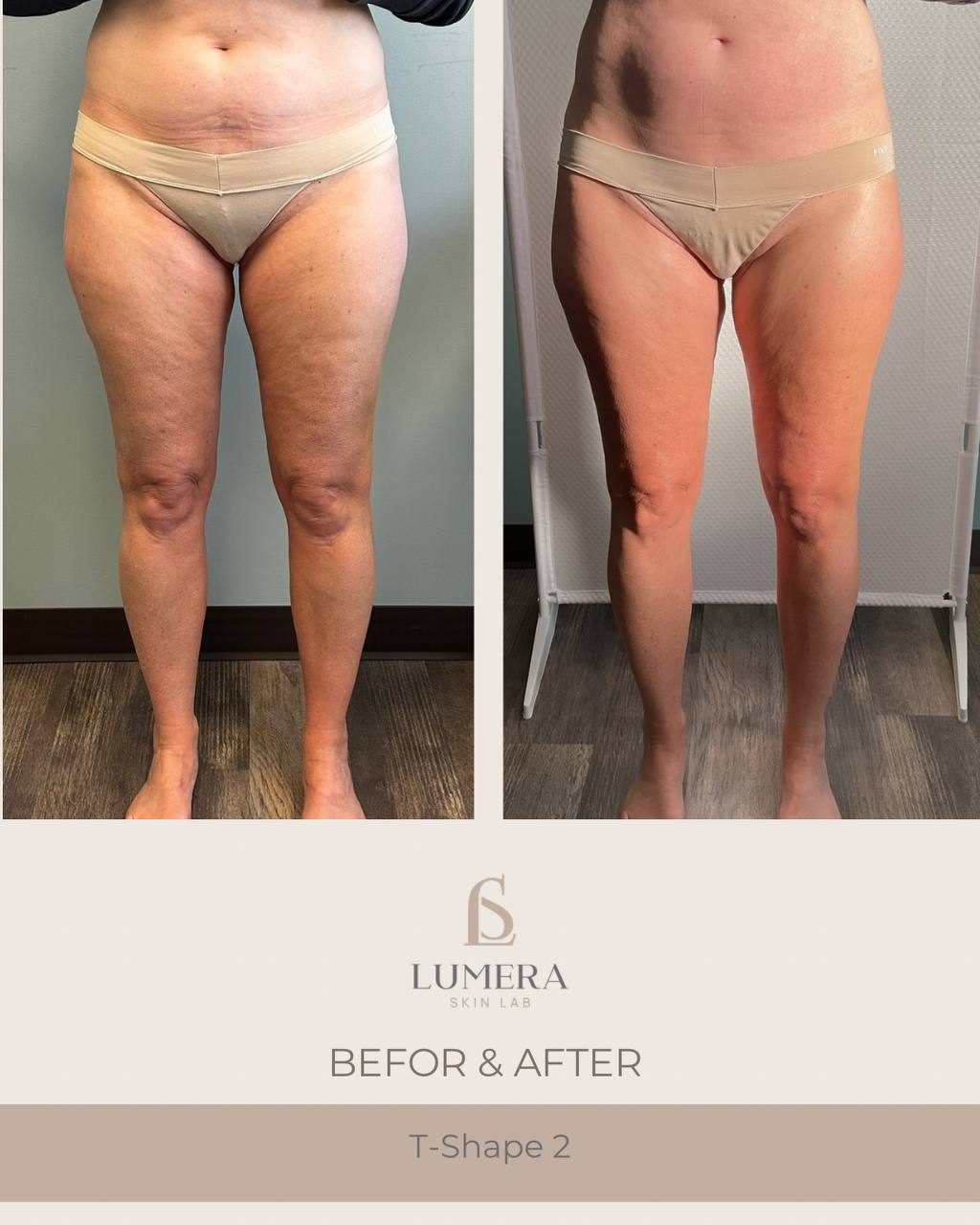 Before and after results of lymphatic drainage massage NYC at Lumera Skin Lab in Midtown Manhattan showing visible body sculpting and de-bloating.