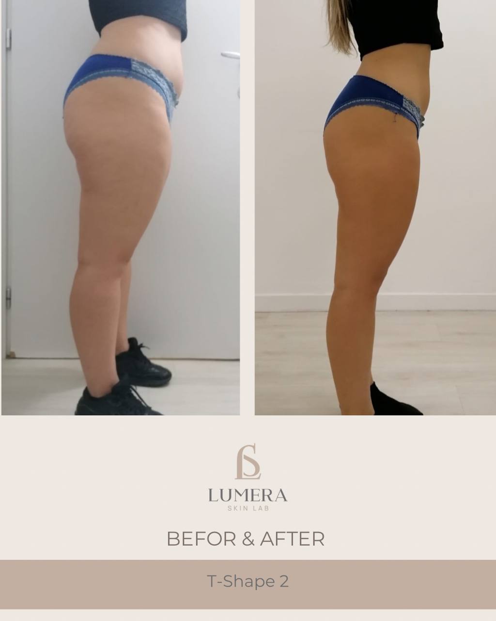 Before and after results of lymphatic drainage massage NYC at Lumera Skin Lab in Midtown Manhattan showing visible body sculpting and de-bloating.