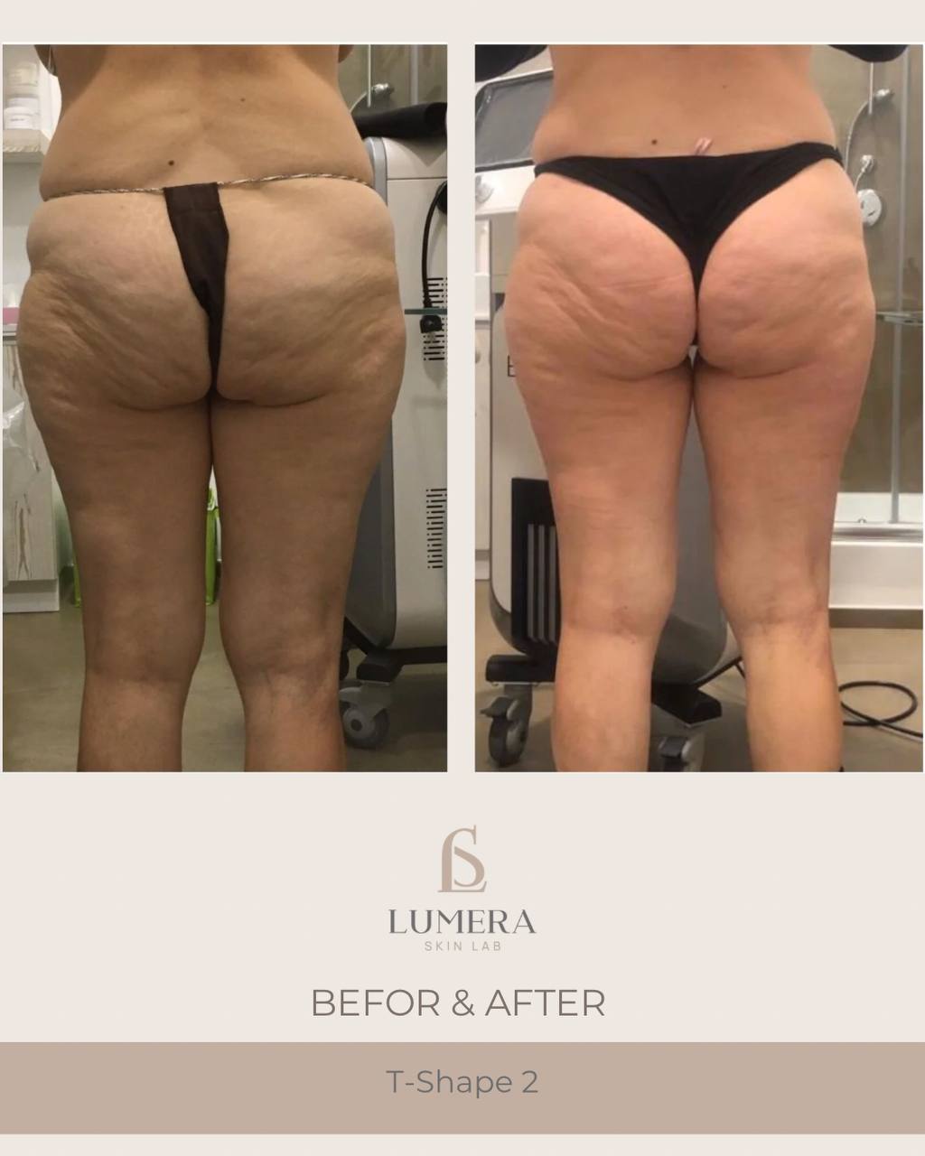 Before and after results of lymphatic drainage massage NYC at Lumera Skin Lab in Midtown Manhattan showing visible body sculpting and de-bloating.