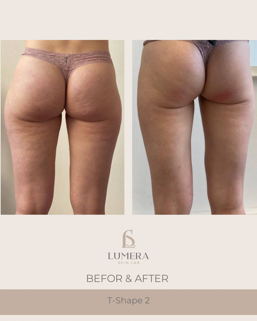 Before and after results of lymphatic drainage massage NYC at Lumera Skin Lab in Midtown Manhattan showing visible body sculpting and de-bloating.