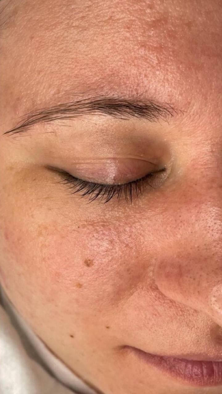 Dermaplaning and chemical peel results NYC Lumera Skin Lab