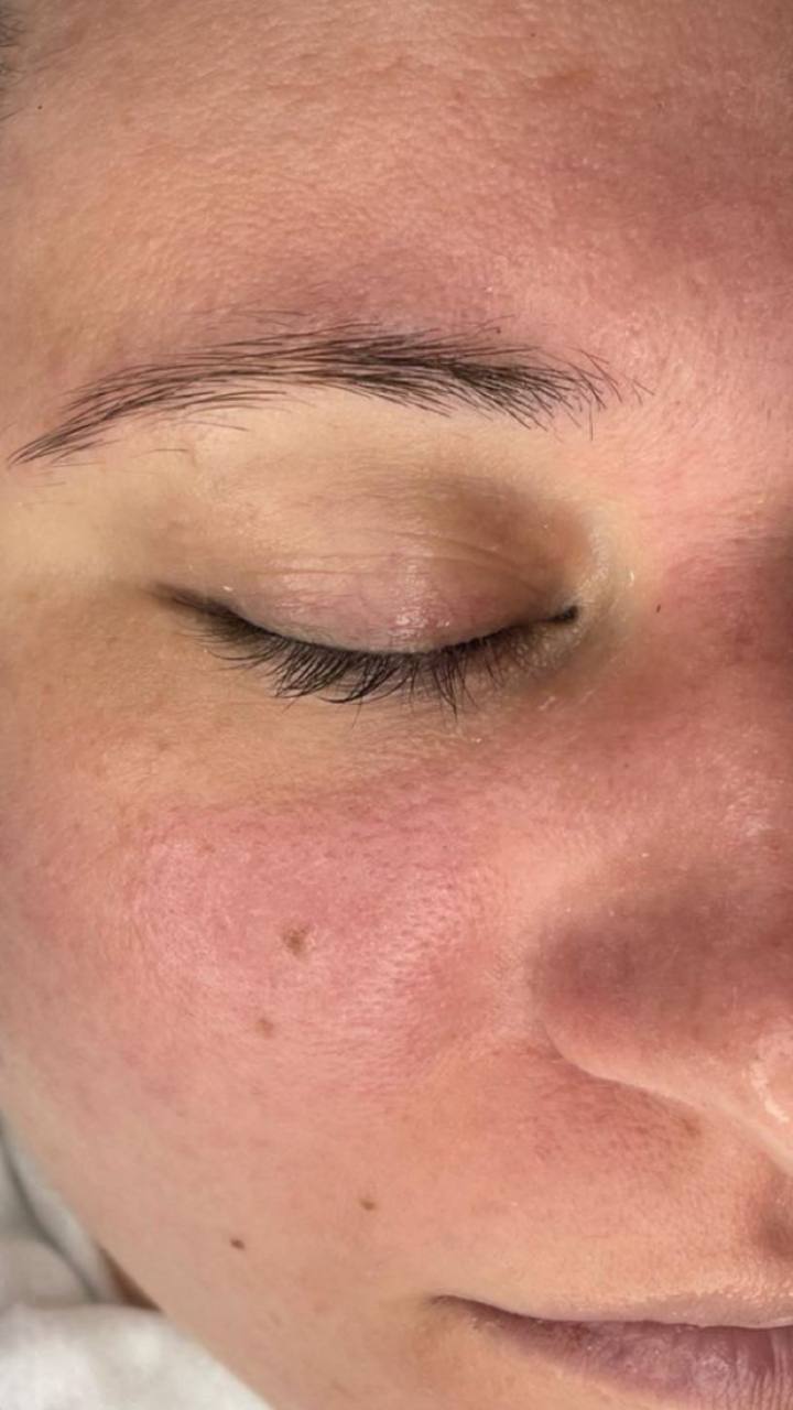 Dermaplaning and chemical peel results NYC Lumera Skin Lab