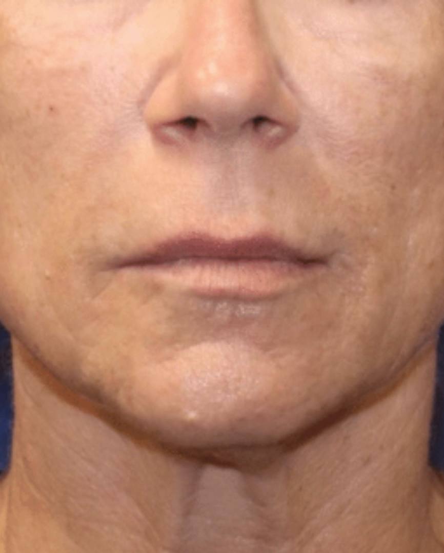 scars before and after results using Pixel8 RF Microneedling NYC in Midtown Manhattan.
