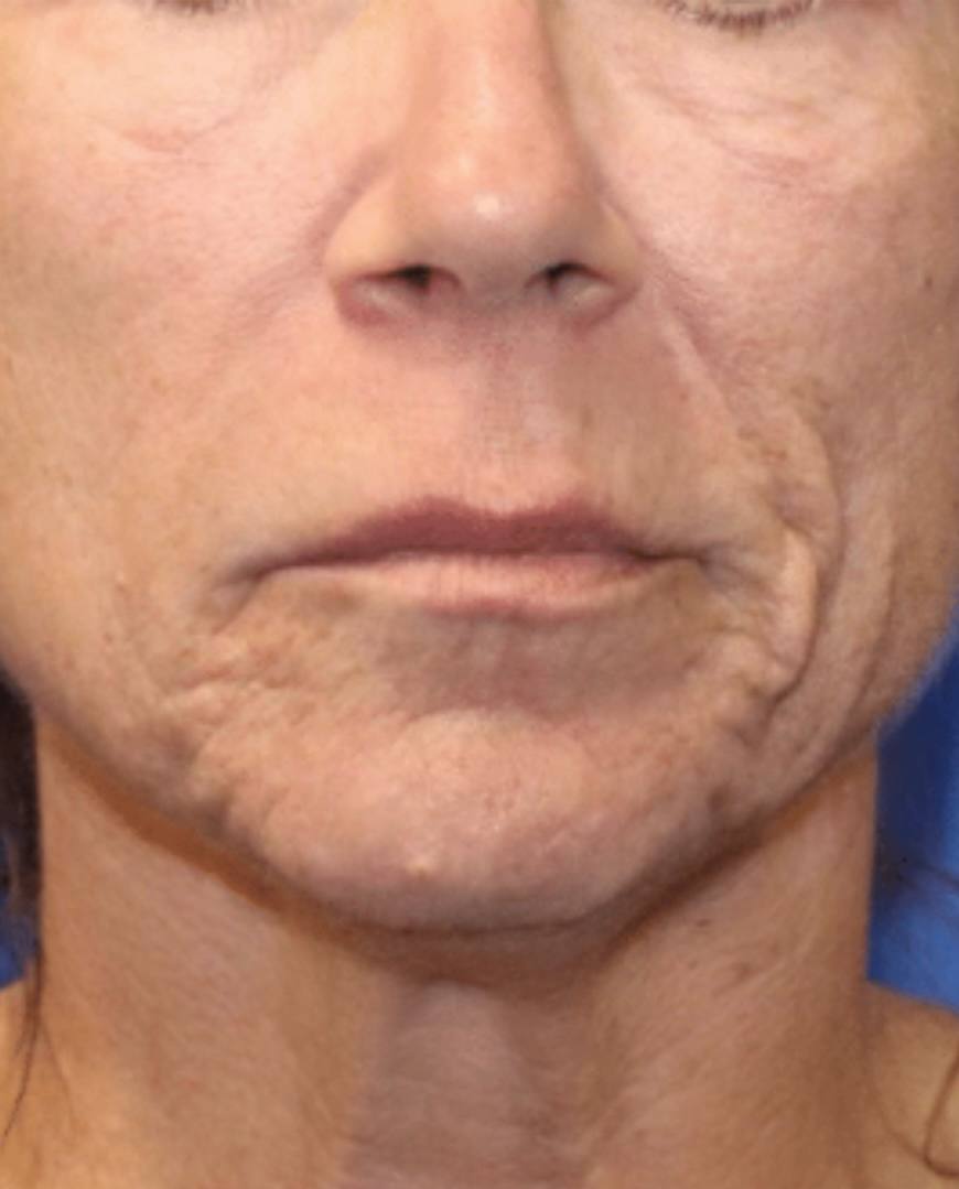 scars before and after results using Pixel8 RF Microneedling NYC in Midtown Manhattan.