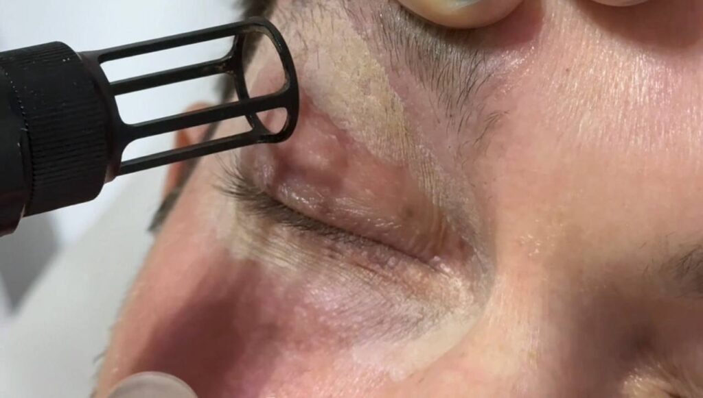 Under eye wrinkles treatment using Erbium laser in New York City