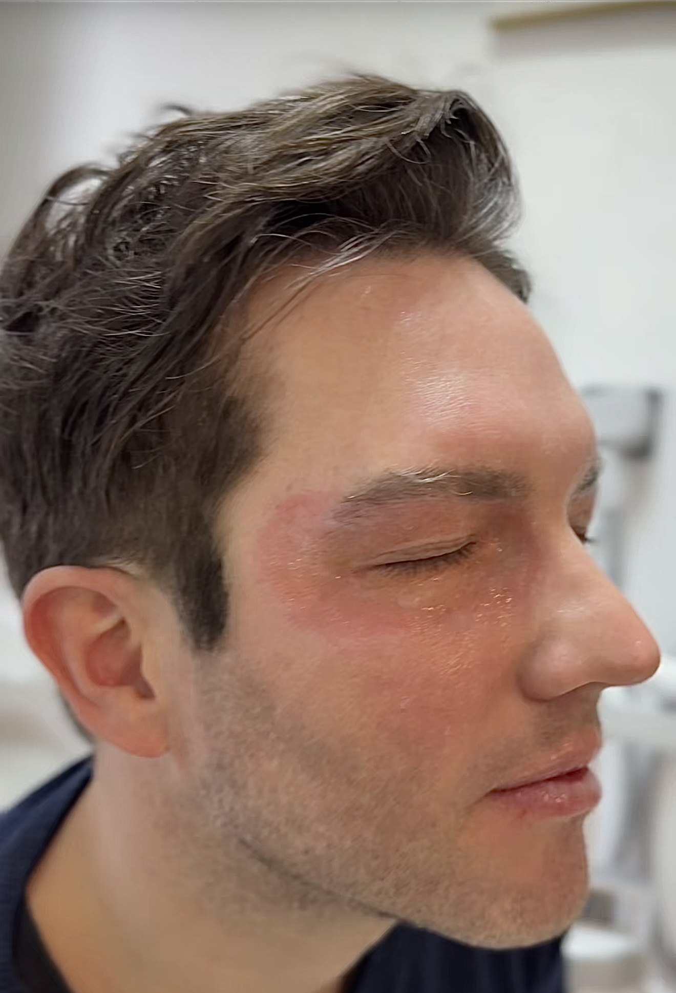 ast recovery after Erbium Laser Resurfacing NYC in Midtown Manhattan